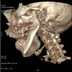 Scanner : reconstruction 3D de la mandibule